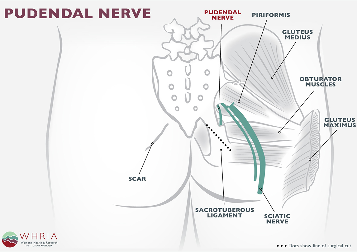 pudendal nerve damage