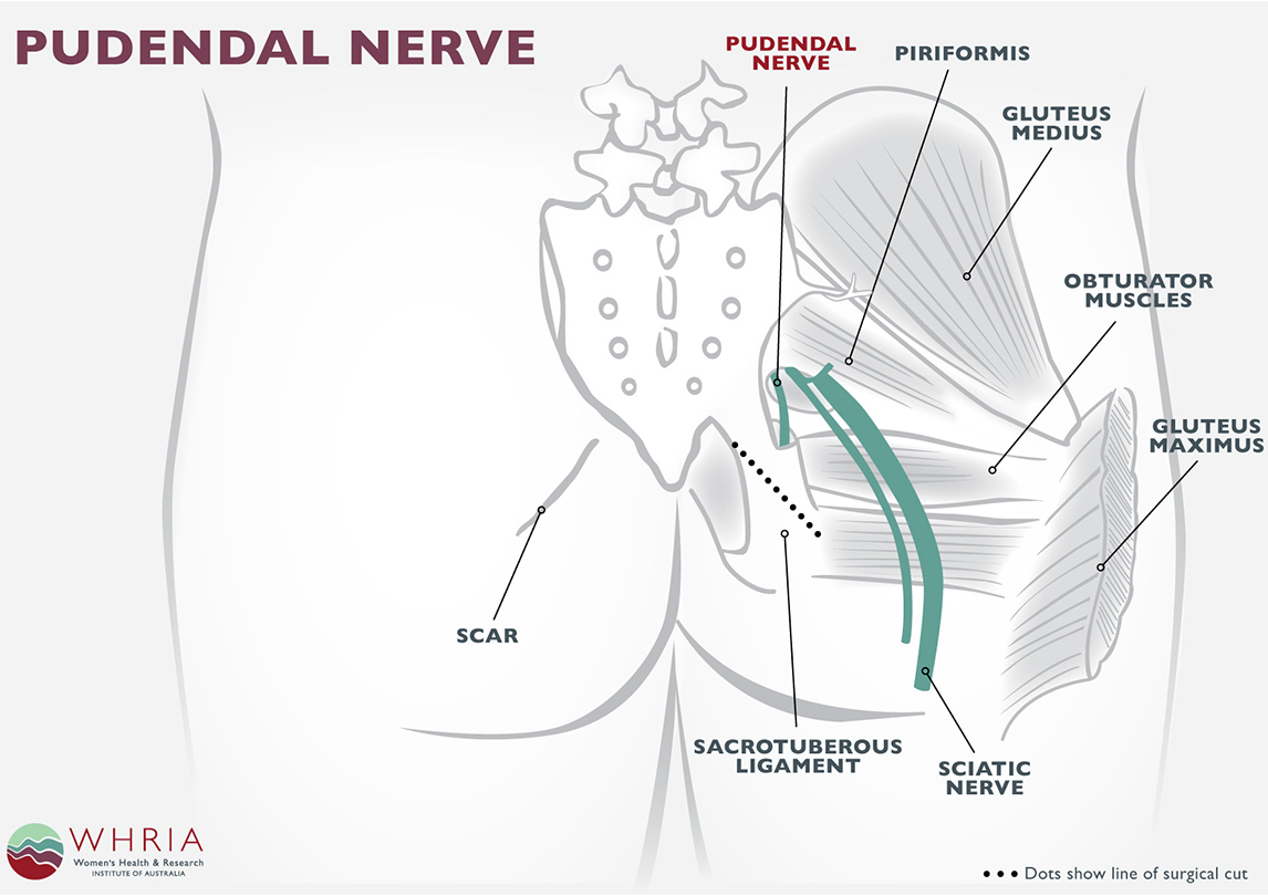 pudendal neuralgia treatment